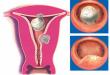 Fremmedlegemer i livmoderen