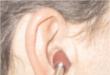 Замена на мембраните и врвовите на ушите